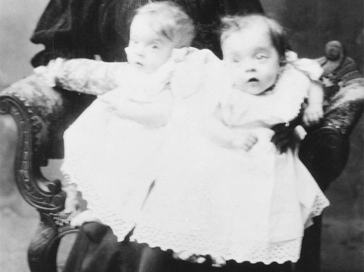 Together Forever: The Conjoined Hilton Twins Not Even Death Could Do ...